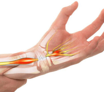 انگشت ماشه شناخت وبهترین وموثرترین درمان