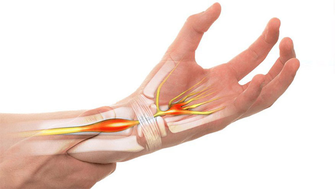 انگشت ماشه شناخت وبهترین وموثرترین درمان