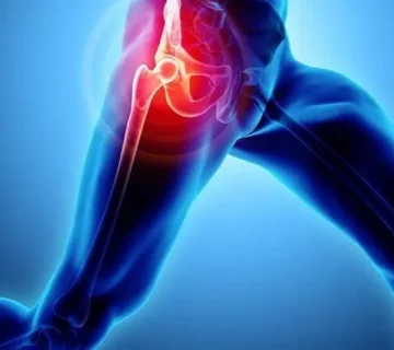 سندرم اسنپینگ هیپ .شناخت علائم ، درمان به راحتترین شکل ممکن