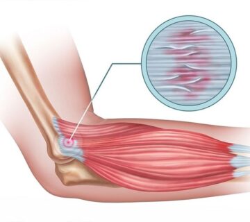 آرنج تنیس بازان -شناخت علائم  ، پیشگیری  به همراه بهترین راههای درمان
